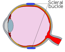 Diagram of an eye with a scleral buckle, in cross-section.